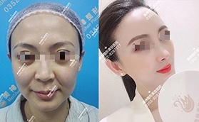 大同美神整形醫(yī)院官網(wǎng)自體肋骨隆鼻手術(shù)前后對比案例