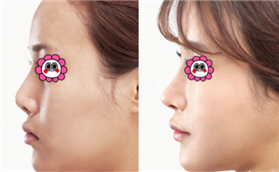 廊坊凱潤婷鼻綜合整形案例