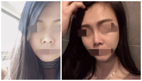 煙臺(tái)壹美天成整形醫(yī)院假體隆鼻案例