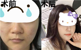 鼻翼肥大寬厚鼻梁低的土妞秒變高鼻梁氣質(zhì)女