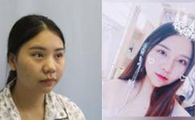 在洛陽(yáng)孔繁榮醫(yī)療美容門診部進(jìn)行眼鼻綜合后華麗變身