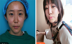 決定來北京做眼修復(fù)，看了麗星翼美案例圖和價格之后就做