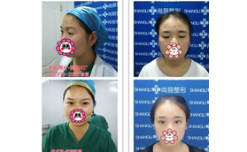 寧波尚麗本院員工雙眼皮整形案例對比