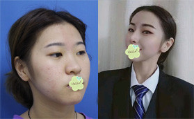 再做膨體肋軟骨隆鼻前,我也超擔(dān)心肋骨鼻頭會(huì)吸收多少