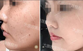 太原歐美蓮超皮秒祛斑前后對(duì)比案例