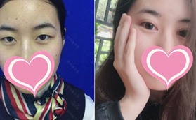 常州施爾美整形基礎(chǔ)眼綜合術(shù)前術(shù)后對(duì)比效果