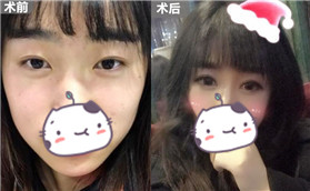做完全切雙眼皮+開(kāi)內(nèi)眼角手術(shù)后，就是不一樣了