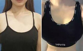 海南華美醫(yī)學美容醫(yī)院找王武院長做了假體隆胸，效果明顯