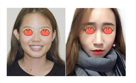 做了鼻綜合整形后，再也不擔心變回塌鼻子了