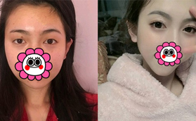 太原華美眼綜合前后對比案例