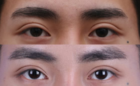 大連愛(ài)德麗格雙眼皮修復(fù)對(duì)比案例