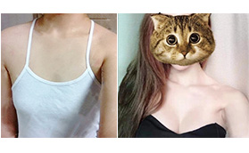 煙臺(tái)洛神整形美容醫(yī)院假體隆胸案例