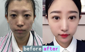 沈陽元辰醫(yī)院光電美膚除斑案例