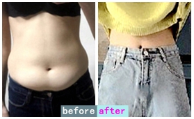 沈陽匯美人腰腹部吸脂案例