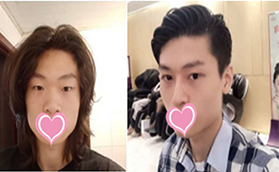 北京華韓余恩旭切開雙眼皮+膨體隆鼻價(jià)格合理效果自然