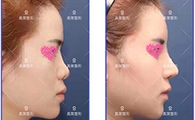 恩施奧萊整形醫(yī)院假體隆鼻手術前后案例對比照片