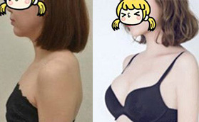 在海南瑞韓做的進(jìn)口曼托假體隆胸手術(shù)，看看效果怎么樣