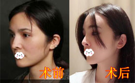 隆鼻失敗鼻梁歪斜沖深圳非凡梅夠明口碑找他做鼻綜合修復(fù)
