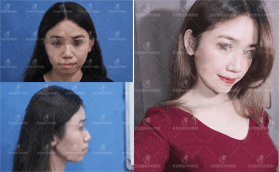 恩施天后整形醫(yī)院硅膠假體墊下巴案例前后對(duì)比照