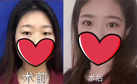 杭州藝星醫(yī)療美容醫(yī)院雙眼皮案例