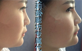 廊坊艾美整形玻尿酸豐下巴案例