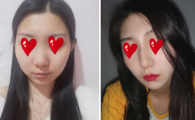 我還在上大學(xué)的時(shí)候攢錢去貴陽(yáng)美貝爾做的假體隆鼻手術(shù)