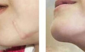 在海南東湖整形做RDL深層再生祛疤術(shù)之祛疤，案例對比明顯