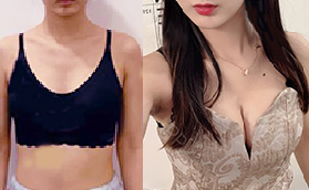 胸小不敢穿吊帶，羨慕胸大的女生，假體隆胸我來了！