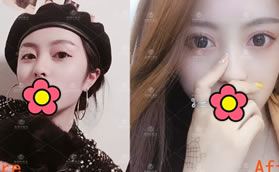 蕪湖伊萊美翟奔宇雙眼皮案例:找他做過眼睛的菇涼都好看了!