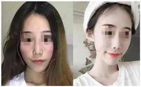 武漢藝星整形自體脂肪面部填充