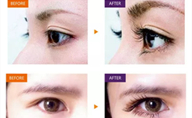 永州傾城醫(yī)美整形醫(yī)院埋線雙眼皮手術(shù)案例