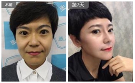 鞍山鐵東區(qū)張玉霞星范醫(yī)療鼻部綜合案例