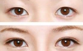 金華心藝整形雙眼皮整形前后對比效果