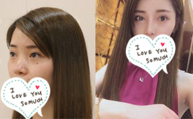 硅膠隆鼻1個(gè)月恢復(fù)效果讓你了解蚌埠華美章華做鼻子好嗎?