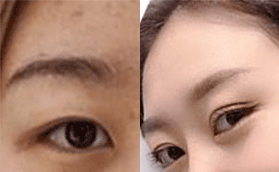 ?？诩t妝尚劉志坤醫(yī)生芭比眼綜合手術(shù)的優(yōu)勢(shì)以及案例分享