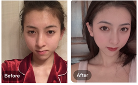 南京華韓奇致美容醫(yī)院章宏偉自體脂肪填充案例