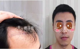 北京毛發(fā)種植哪家醫(yī)院做的好？北京碧蓮盛毛發(fā)種植多錢(qián)？