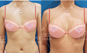 杭州美萊醫(yī)療整形醫(yī)院假體隆胸案例