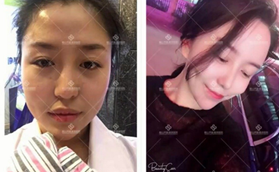 鞍山齊敏美容醫(yī)院鼻綜合手術(shù)案例