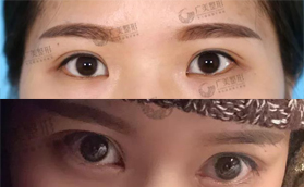 廣州廣美美雅整形自然無痕開眼角前后案例對比照