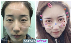 沈陽名流自體脂肪全臉填充+經(jīng)典全切雙眼皮案例