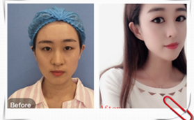 南京美貝爾整形醫(yī)院黃名斗醫(yī)生切開雙眼皮手術案例