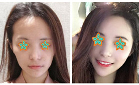 在哈爾濱諾依美做自體脂肪填充面部3個(gè)月后給出恢復(fù)照片