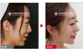 鞍山燕麗美容醫(yī)院面部脂肪填充+鼻部綜合改善案例