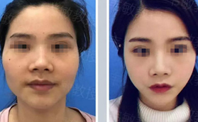 兩位顴骨突出的小姐姐為什么都說做完顴骨內(nèi)推術(shù)后悔死了