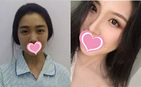 永州博美整形醫(yī)院陳兵醫(yī)生硅膠隆鼻整形手術(shù)案例