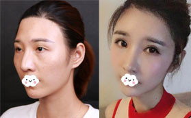 大方承認(rèn)我的肋軟骨隆鼻是找深圳美萊梁曉健院長做的