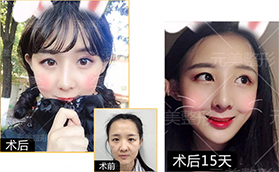 青島元美整形美容醫(yī)院鼻部多項(xiàng)案例分享