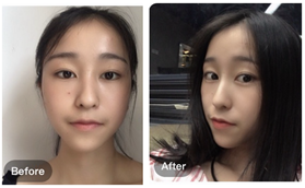 江蘇南京施爾美整形美容醫(yī)院李彤彤硅膠隆鼻案例