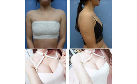 FDA+CE雙重認(rèn)證的傲諾拉閃耀假體，這手感10萬的價格也認(rèn)了